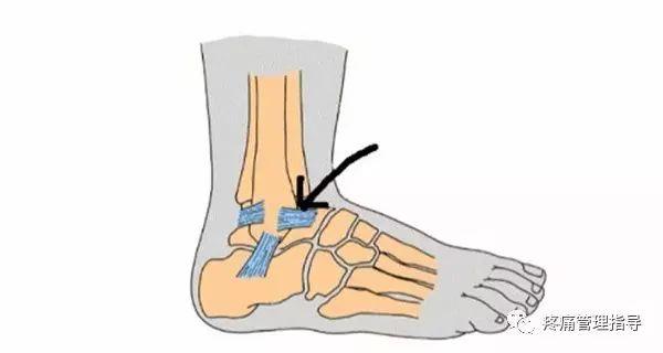nba脚踝歪着肿了怎么办 NBA球星脚踝扭伤的处理方法(11)
