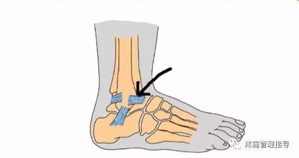 nba脚踝歪着肿了怎么办 NBA球星脚踝扭伤的处理方法(13)
