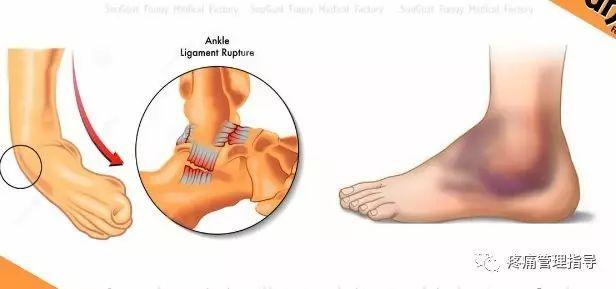 nba脚踝歪着肿了怎么办 NBA球星脚踝扭伤的处理方法(18)