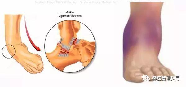 nba脚踝歪着肿了怎么办 NBA球星脚踝扭伤的处理方法(19)