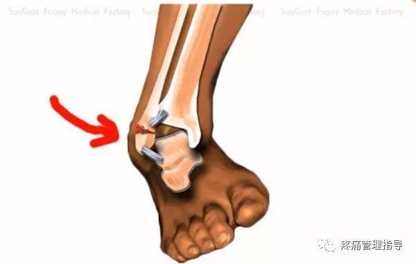 nba脚踝歪着肿了怎么办 NBA球星脚踝扭伤的处理方法(21)