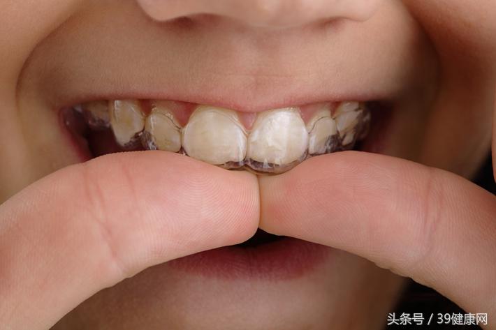 nba带的运动护牙套 运动戴护牙套有必要吗(3)